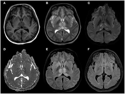 Detection of Japanese Encephalitis by Metagenomic Next-Generation Sequencing of Cerebrospinal Fluid: A Case Report and Literature Review